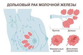 рак молочной железы, уплотнение молочной железы, маммолог, онколог
