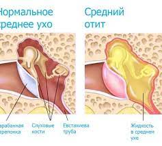 отит, боль у ухе, ЛОР