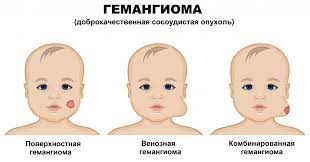 гемангиома, родимое пятно, сосудистая опухоль, онколог, дерматолог, сосудистый хирург