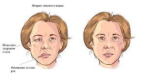 паралич лица, нарушение обоняния паралич лица, нарушение обоняния
