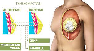 увеличение грудной железы, свисание грудных мышц