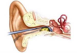 Серная пробка.jpg