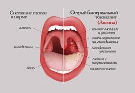 ангина, тонзиллит, симптомы заболеваний