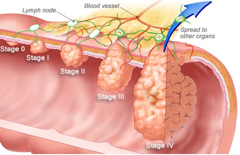 winslow_rm_illustration_of_colorectal_cancer_stages.jpg winslow_rm_illustration_of_colorectal_cancer_stages.jpg