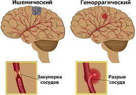 инсульт, паралич, гипертоническая болезнь