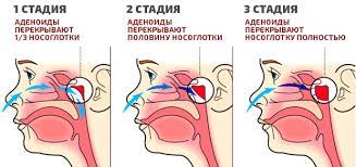 аденоидит, затруднение носового дыхания