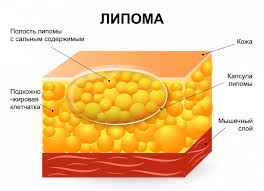 липома кожи, липома молочной железы, шишка в коже, жировик, хирург, гинеколог