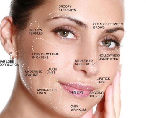 dermal-fillers-face-map-495x400.jpg