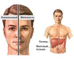 простая семейная холемия, конституциональная гипербилирубинемия, идиопатическая неконъюгированная гипербилирубинемия, Синдром Жильбера, доброкачественная желтуха