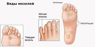 мозоли днепр.jpg мозоли днепр.jpg