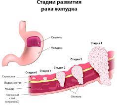 рак желудка, боль в животе, черный кал, онколог, хирург