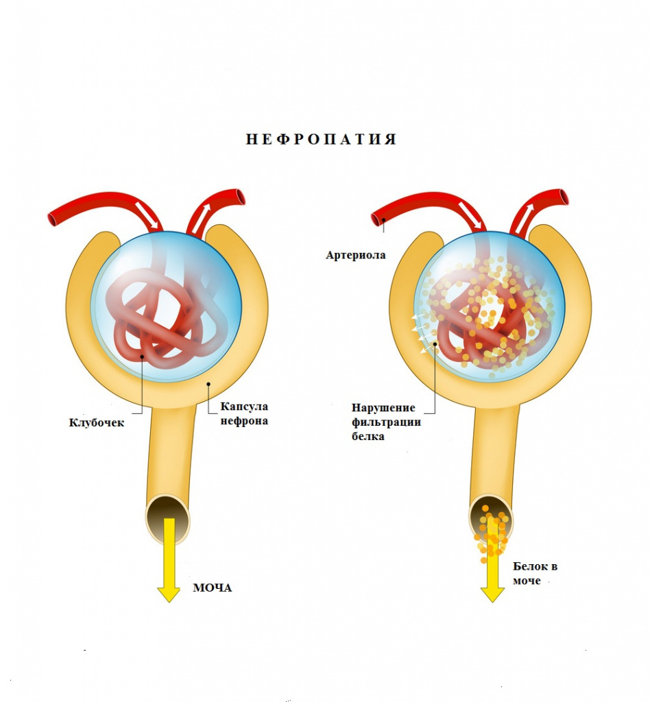 Нефропатия.jpg