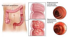 язвенный колит, НЯК, Днепр, Поликлиника Св. Антипы, гастроэнтеролог, колоноскопия