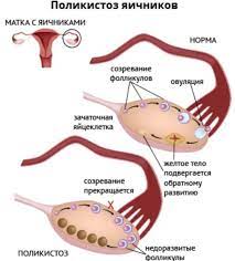 поликистоз яичников, гинеколог, боли в животе