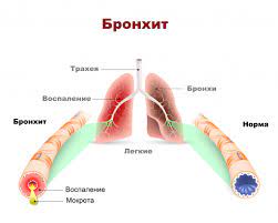 Бронхит, пневмония, хронический кашель