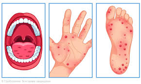 сыпь на коже, болезнь Коксаки, инфекции кожи