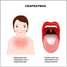 скарлатина, дифтерит, боль в горле, педиатр, инфекции скарлатина, дифтерит, боль в горле, педиатр, инфекции