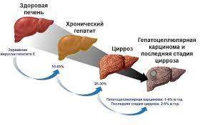 Гепатит: симптомы, лечение, диагностика, Поликлиника Св. Антипы, Днепр