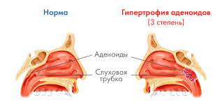 аденоиды, затрудненное носовое дыхание, гнусавость