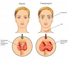 гипертиреоз, заболевания щитовидной железы, эндокринолог