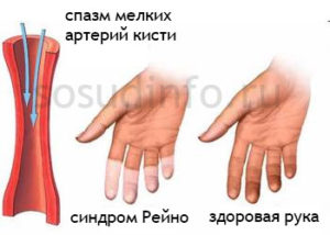 Днепр поликлиника Св. Антипы невролог синдром Рейно