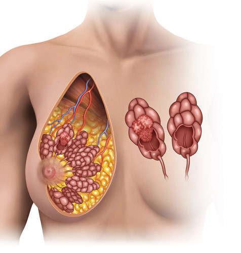 benign-breast-disease.jpg benign-breast-disease.jpg
