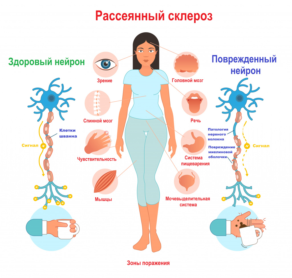 рассеянный склероз, механизм поражения нервной системы рассеянный склероз, механизм поражения нервной системы