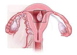 полипы матки, эндометрия, осложнения