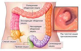 рак толстой кишки, кровь в кале, запоры, онколог, хирург