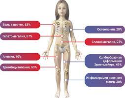 Болезнь Гоше, орфанные заболевания, гастроэнтеролог