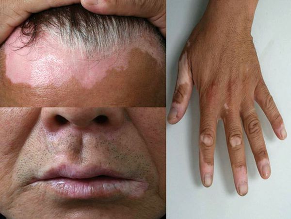 Addison's_disease_dnepr_klinica_st.antipa.jpg Addison's_disease_dnepr_klinica_st.antipa.jpg