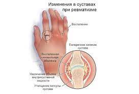 Ревматизм заболевание суставов позвоночник