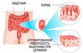 Целиакия. Днепр. Поликлиника Св. Антипы, гастроэнтеролог, колоноскопия