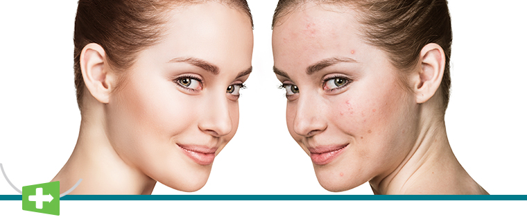 image-Acne-Treatment.jpg