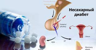 несахарный диабет, полиурия, эндокринолог, гинеколог