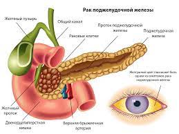 рак поджелудочной железы, желтуха, боль в животе, похудение, онколог, хирург