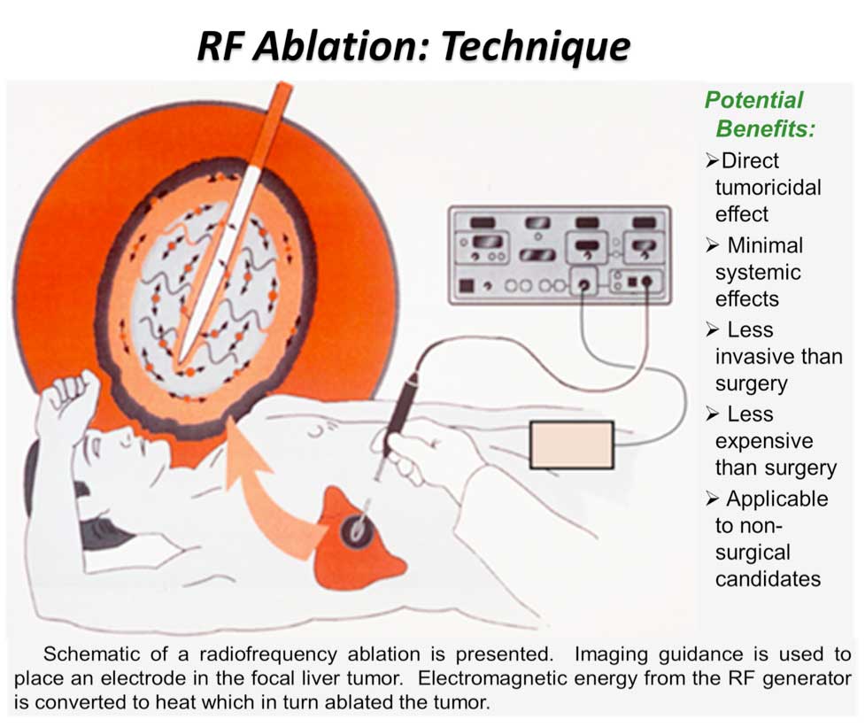 rfa-treatment.jpg