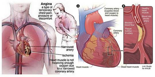 apa-itu-angin-duduk-atau-angina.jpg стенокардия, гипертония, кардиолог, Поликлиника Св. Антипы, Днепр