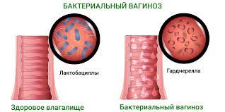 Выделения из влагалища, микрофлора, диагностика