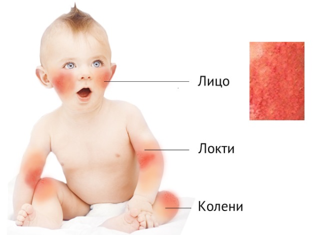 атопик днепр.jpg атопик днепр.jpg