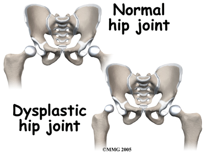 child_hip_devel_dysp_symptoms01.jpg child_hip_devel_dysp_symptoms01.jpg