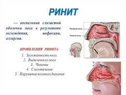 острый ринит, воспаления носа, сопли, насморк, заложенность носа