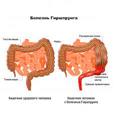 Болезнь Гиршпрунга, болезнь толстой кишки, запоры, гастроэнтеролог