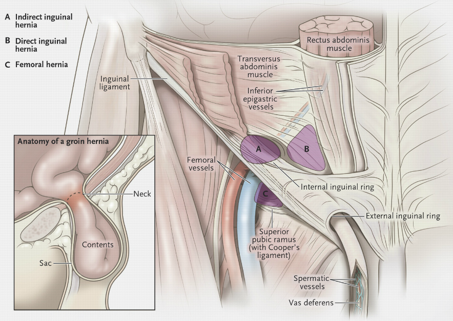 Types-of-Hernia-Large-PIT-post.png