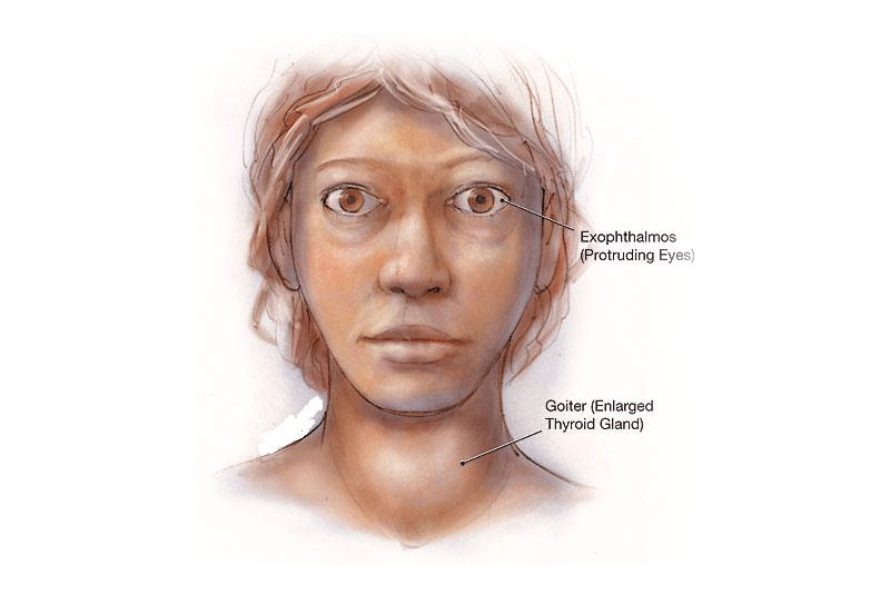 Graves_Disease_thyroid_st.antipa_dnepr_endokrin.jpg Graves_Disease_thyroid_st.antipa_dnepr_endokrin.jpg