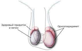 Заболевание яичек воспалительного происхождения