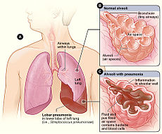 230px-Lobar_pneumonia_illustrated.jpg 230px-Lobar_pneumonia_illustrated.jpg