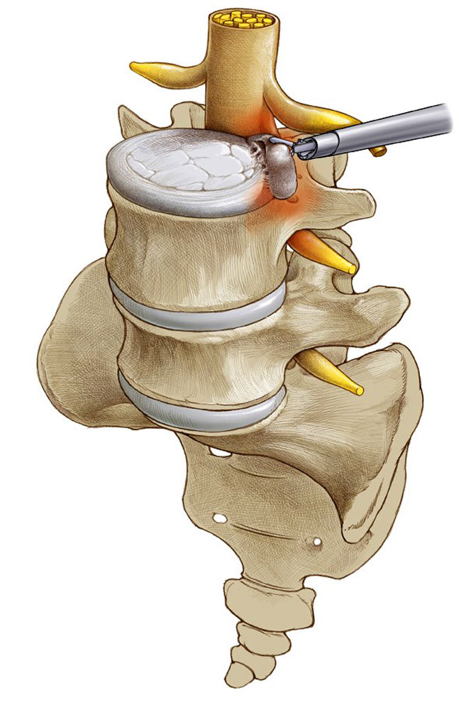 Удаление грыжи в пояснице. Грыжа междисковая позвоночная. Дискэктомия поясничного отдела позвоночника. Операция на грыжу позвоночника поясничного. Микроинвазивная хирургия грыжа позвоночника.