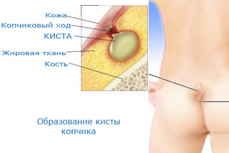 Днепр поликлиника св.Антипы эпителиальный копчиковый ход хирург