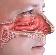 озена, зловонные выделения из носа, сопли